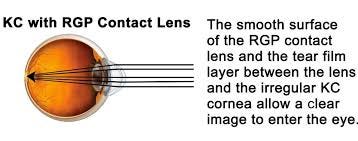 Image result for rigid contact lenses Image result for rigid contact lenses