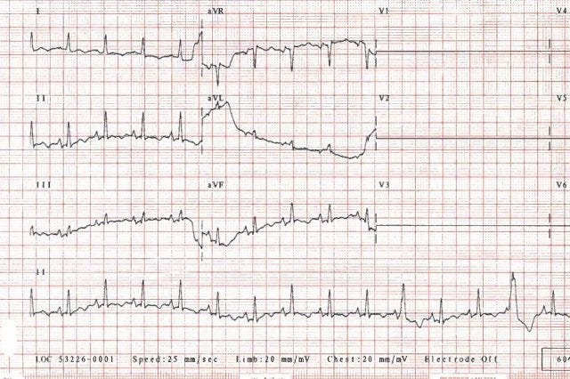 Electrocardiograms (ECGs/EKGs)