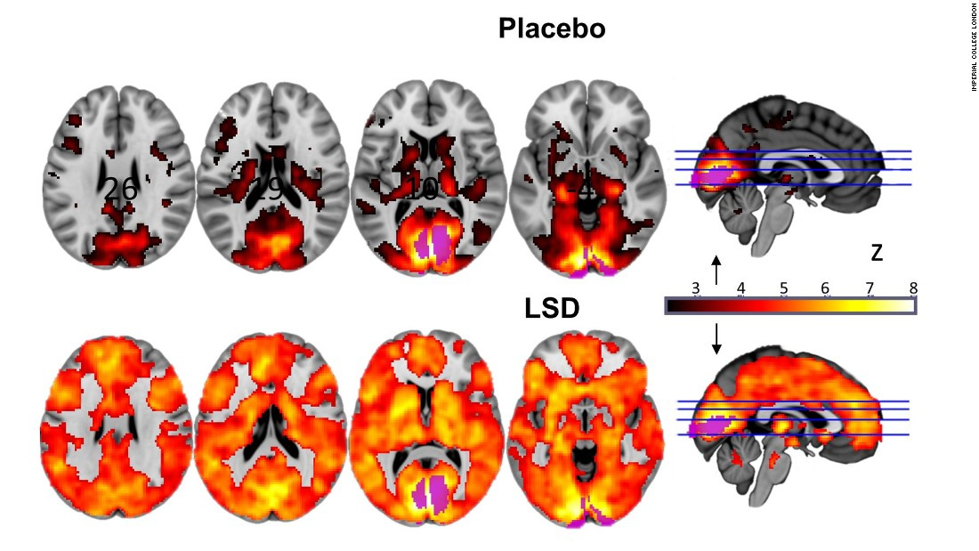 This is your brain on LSD, literally | CNN