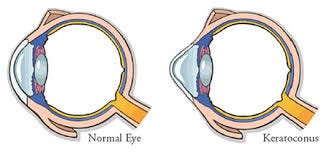 Image result for keratoconus Image result for keratoconus
