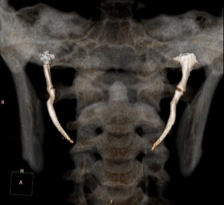 Eagle syndrome | Radiology Reference Article | Radiopaedia.org