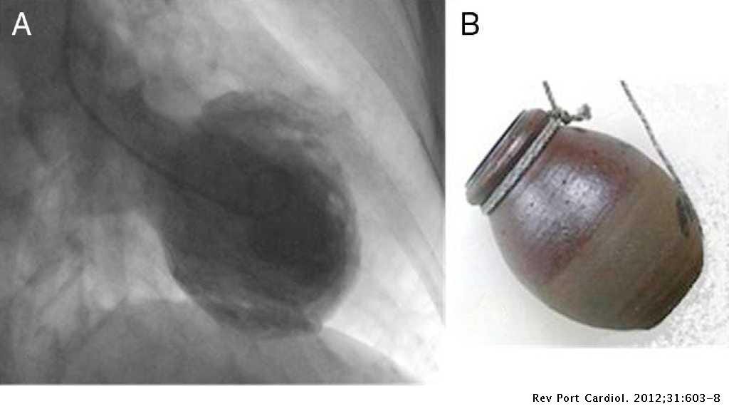 Takotsubo cardiomyopathy in a cardiology department | Revista ...