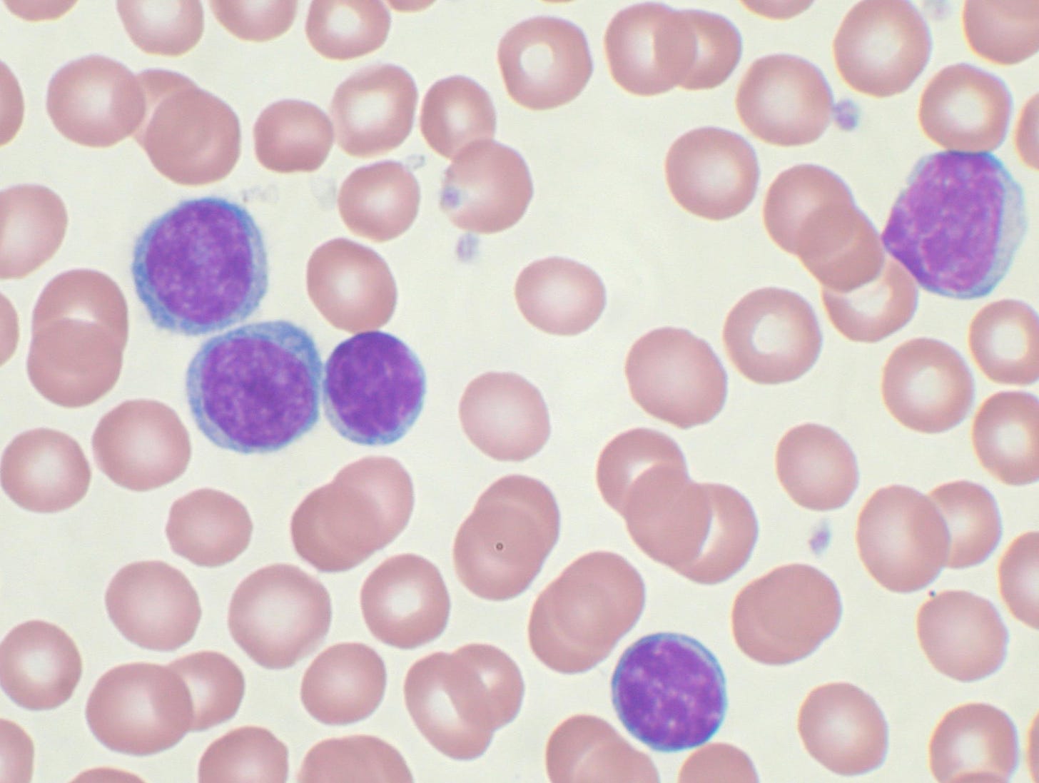 Chronic lymphocytic leukemia - Wikipedia