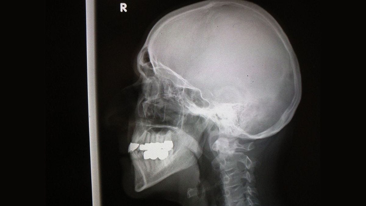 An x-ray photo of a head and neck facing to the left