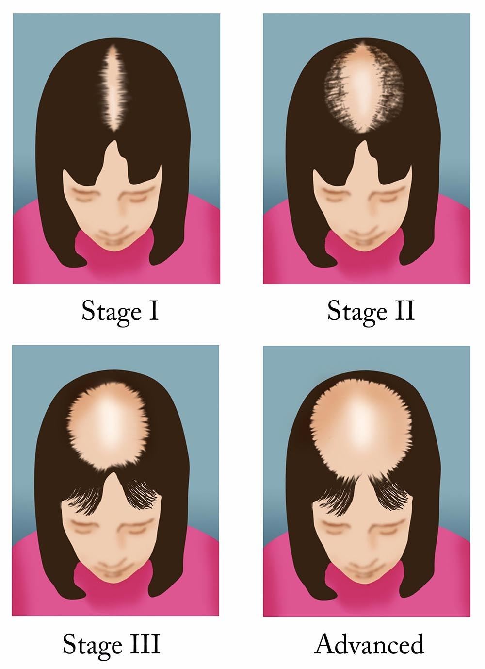 Female pattern baldness | healthdirect