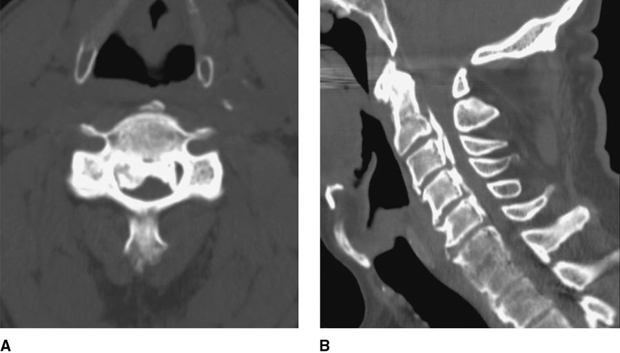 CT imaging of cervical spine with OPLL