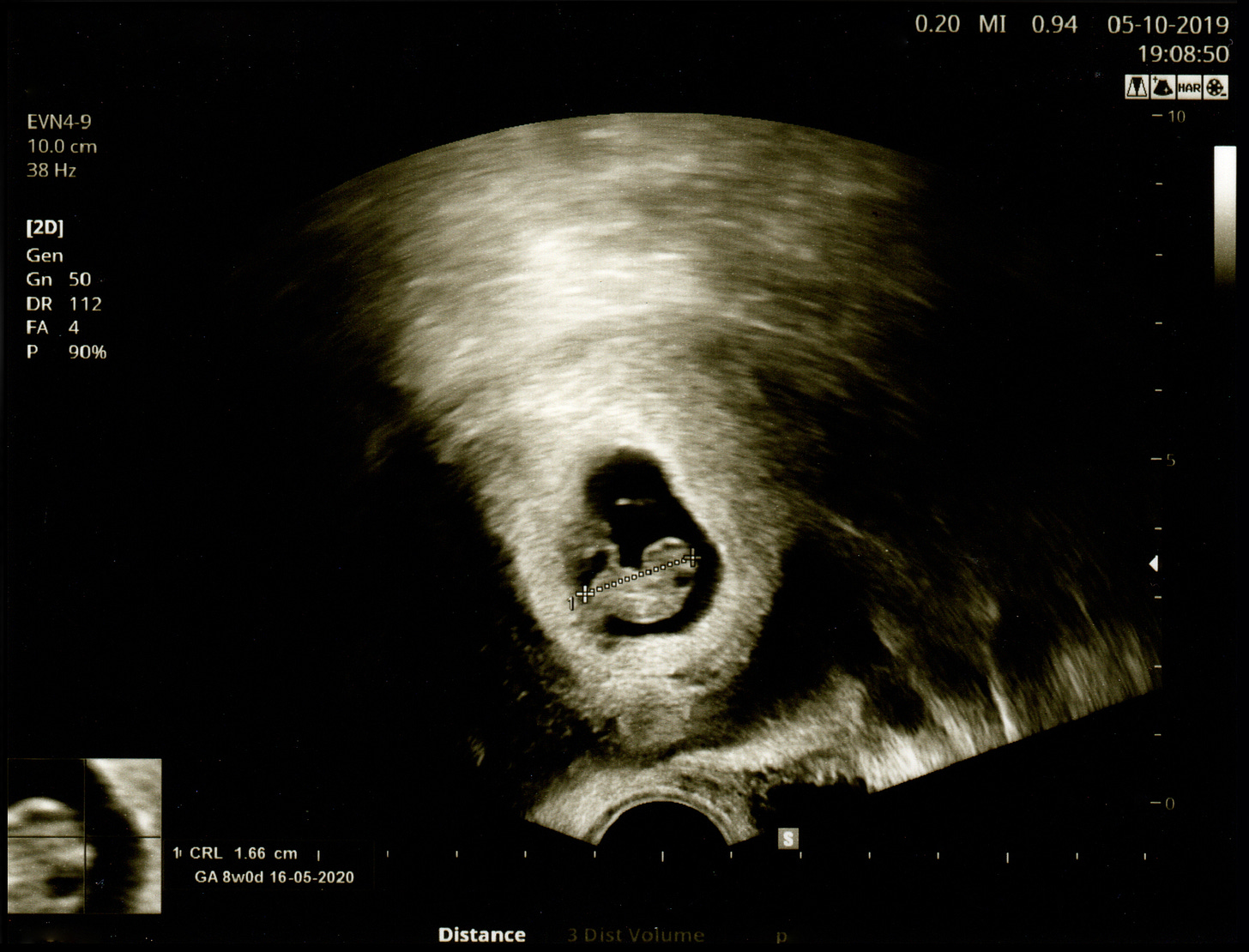 image of an ultrasound film or screenshot showing a small human embryo in the mother's uterus