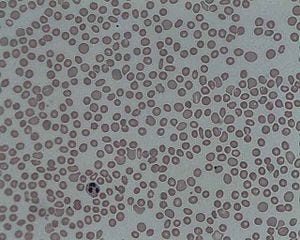 Thrombocytopenia 1.jpg