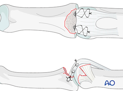 illustration of suture anchor volar plate arthroplasty