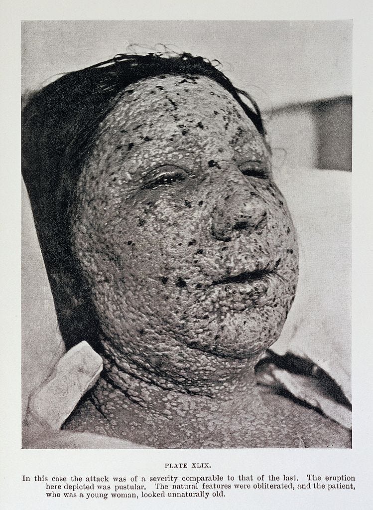 749px-Pustular_eruption_of_smallpox_on_face_Wellcome_L0032957