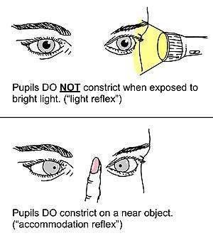 Argyll Robertson pupil light reflex vs accommodation reflex.jpg