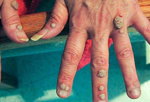 Warts and all – The MS-Blog