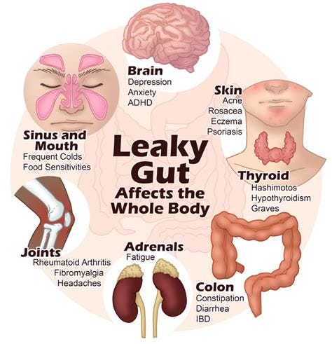 5 Step Formula to Heal Leaky Gut Naturally - Paula Owens