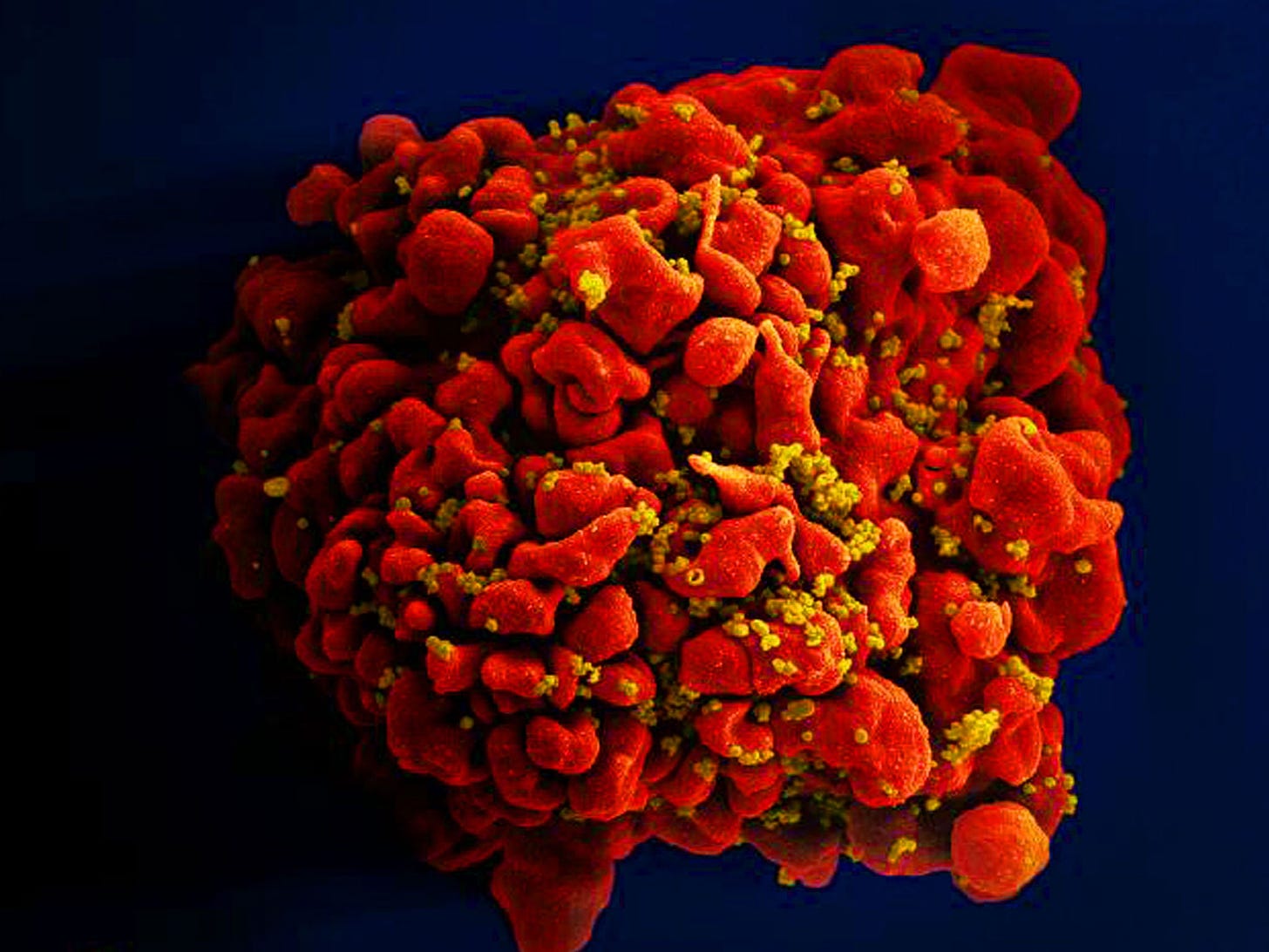 HIV treatment breakthrough creates antibody that attacks ...
