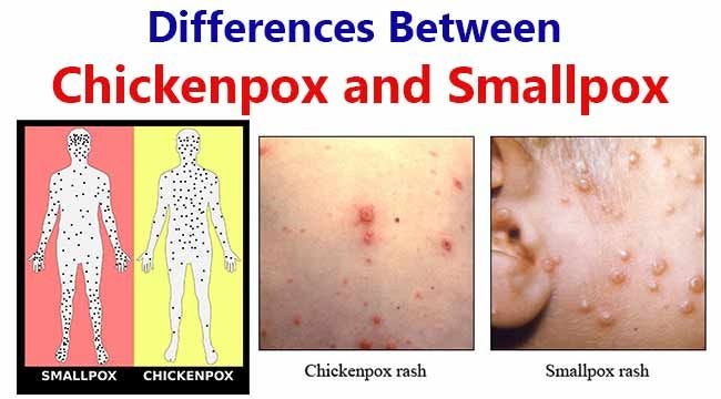 Differences Between Chickenpox and Smallpox