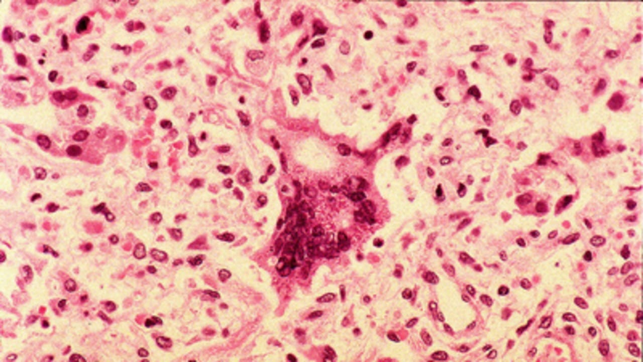 The measles virus as it appears under microscope.