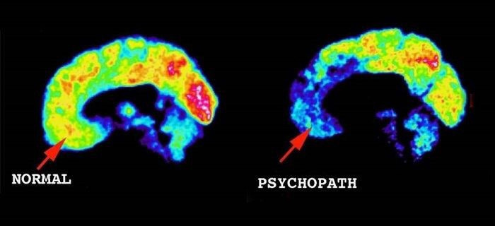 How is the brain image of psychopathy different from a normal person? -  Quora