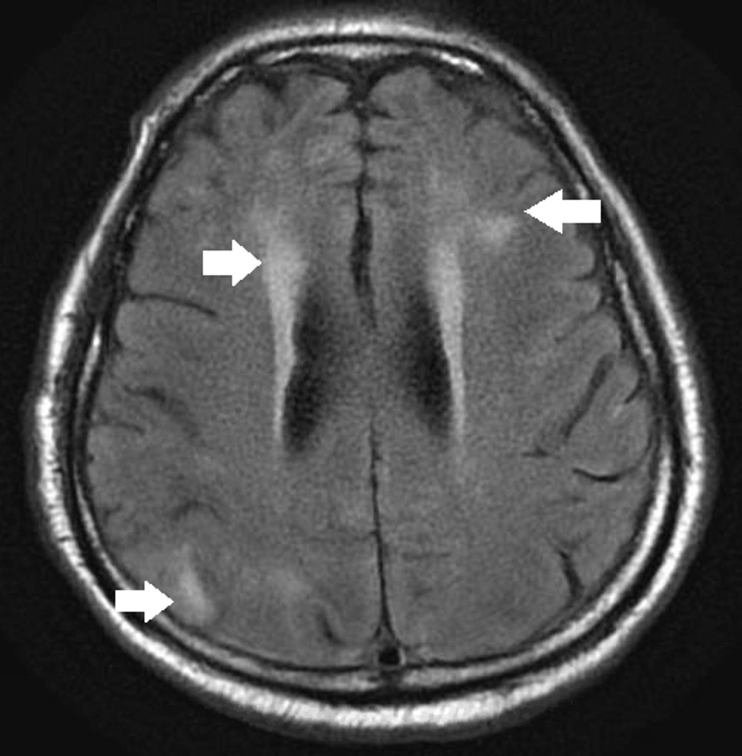 Cureus | COVID-19 and the Brain: Acute Encephalitis as a Clinical  Manifestation