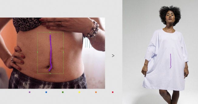 Side-by-side photos: on the left is a close-up of someone's abdomen with a purple line down the middle. On the right, a person wears a t-shirt dress with a purple line in the same spot