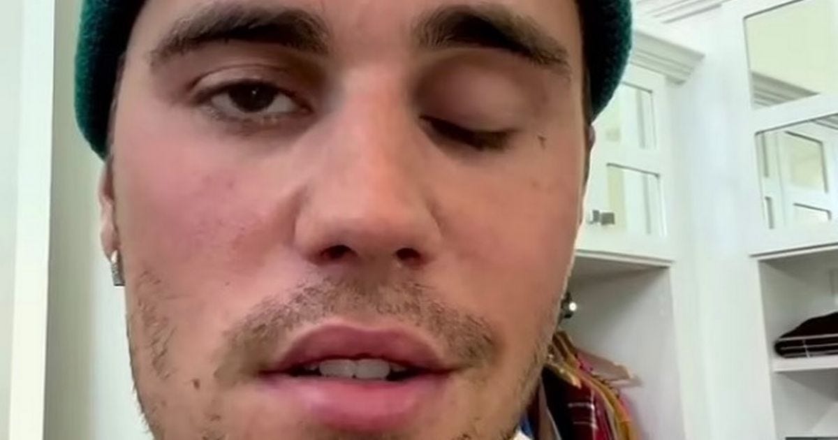 What Is Ramsay Hunt Syndrome As Justin Bieber Reveals Paralysed Face In Video - Todaynewsuk