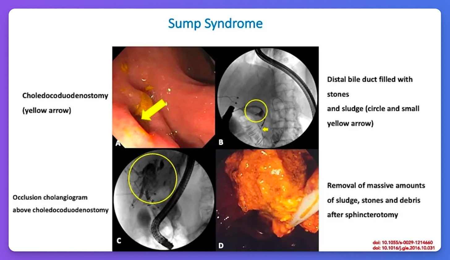 Sump Syndrome