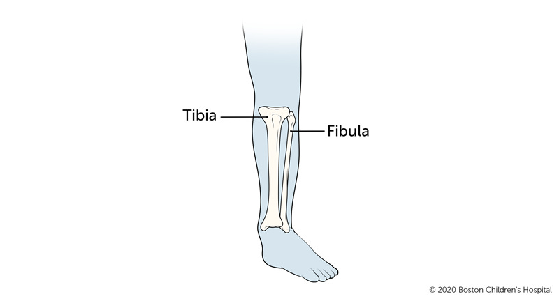Broken Tibia-Fibula (Shinbone/Calf Bone) | Boston Children&#39;s Hospital