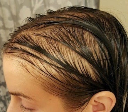 Photo showing hair loss.