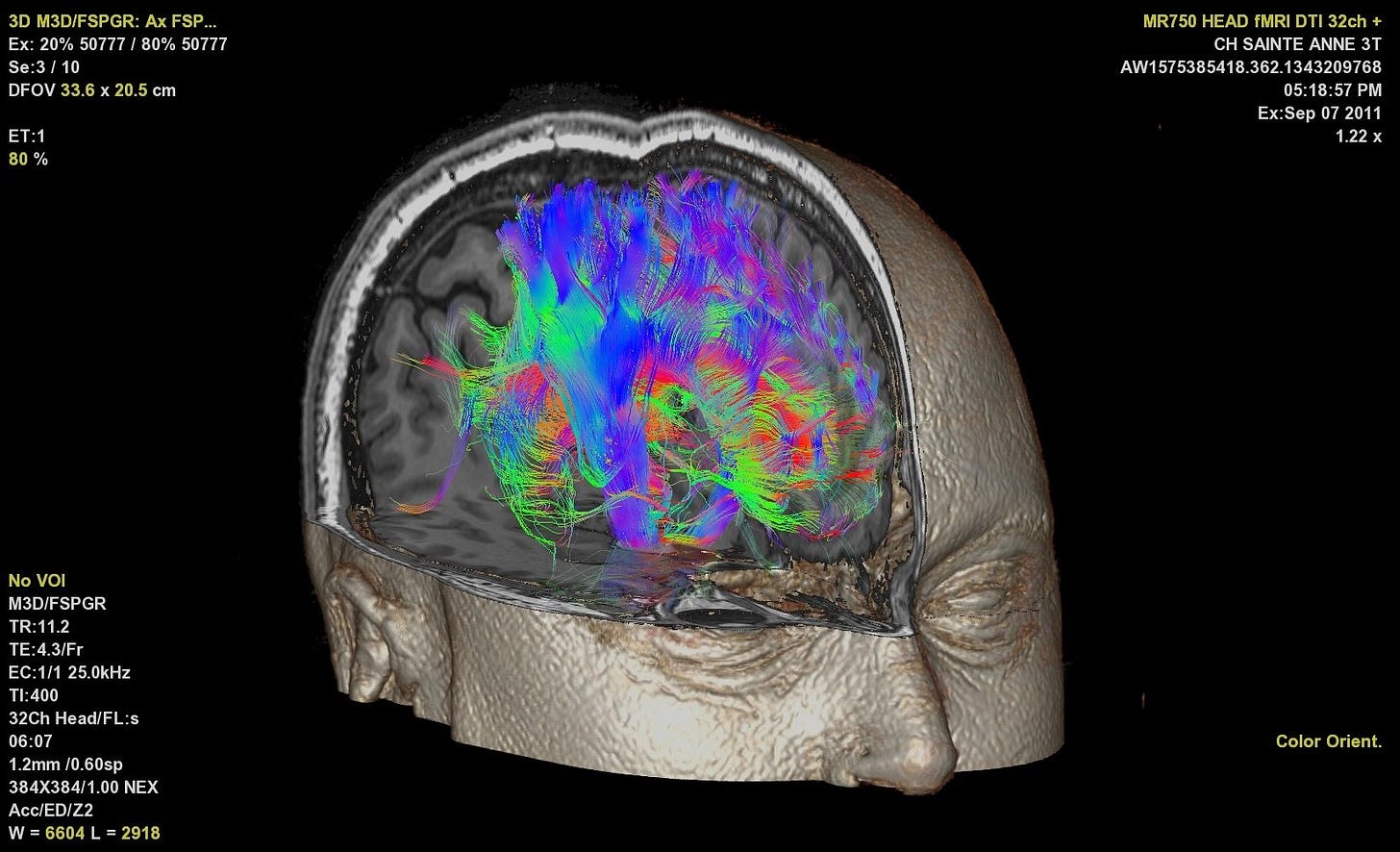 Machine Learning Uncovers New Insights Into Human Brain Through fMRI |  Imaging Technology News