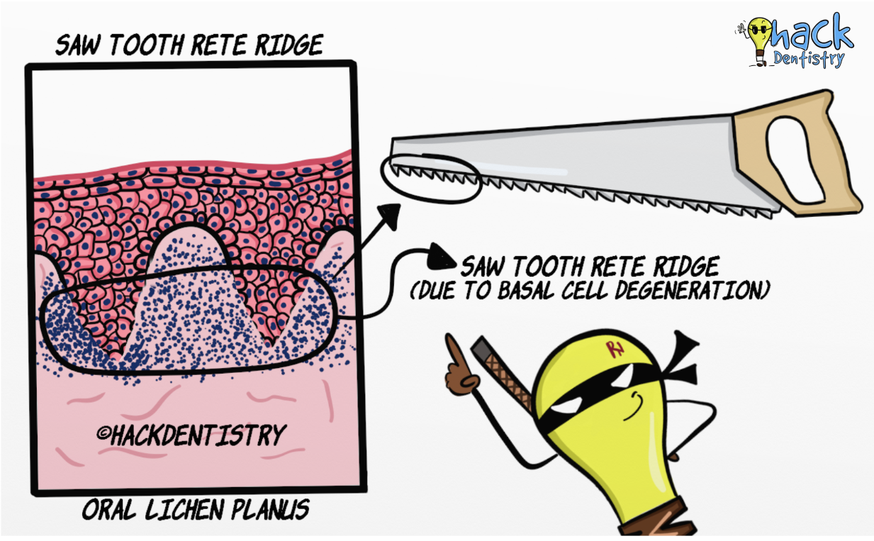 Saw-tooth rete ridge