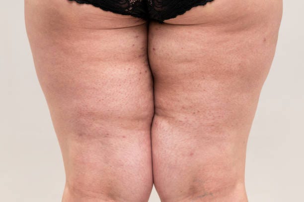 Fat legs with acne on skin, obesity female body Fat legs with acne on skin, obesity female body on gray background thigh chafing stock pictures, royalty-free photos & images