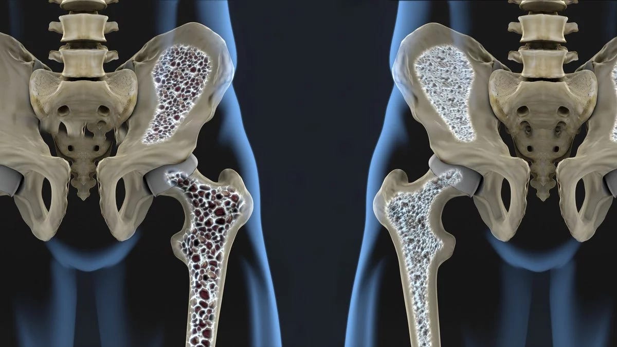 Osteoporosis: síntomas, tratamientos, causas e información