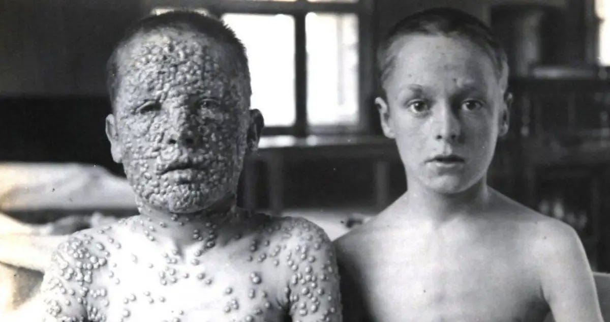 Smallpox Pictures That Reveal The Disease's Devastating History