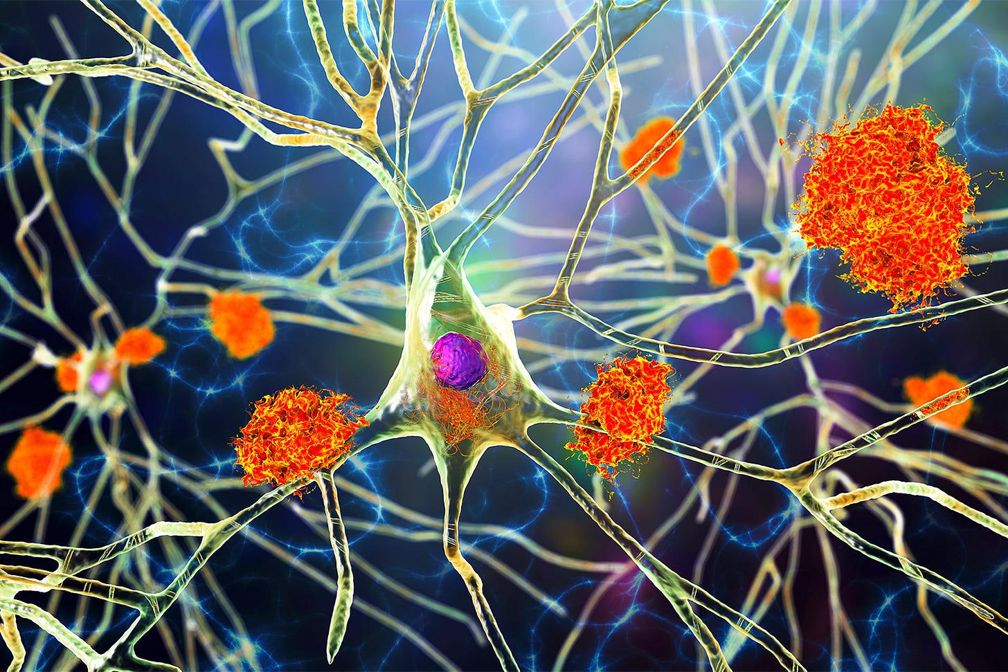 Toxic Fatty Acids to Blame for Brain Cell Death After Initial Injury | NYU  Langone News