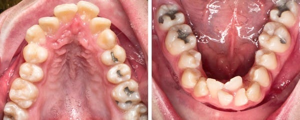 3 Ways to Resolve Orthodontic Crowding | Orange, Artesia, and Laguna Niguel  Orthodontist