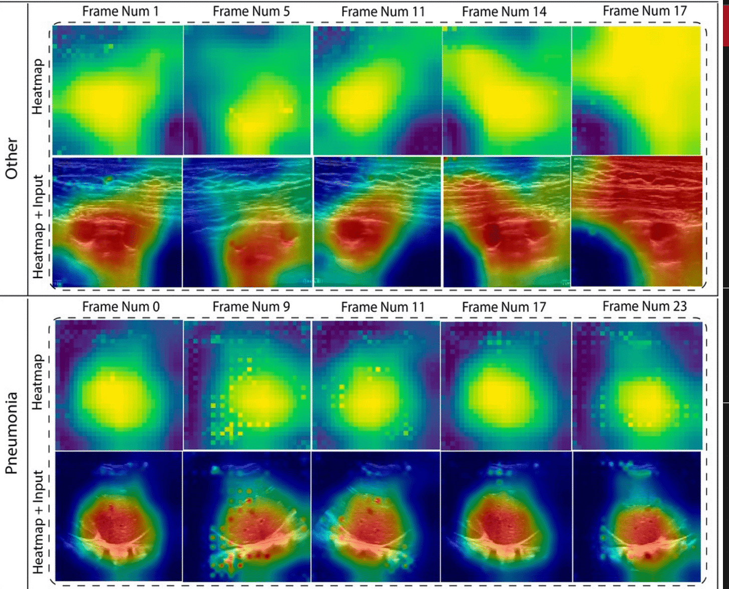 The AI model can recognise signs of pneumonia, which are different from other lung conditions