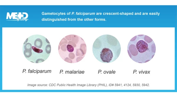 Blood smear highlighting red blood cells that are demonstrating appliqué form of Plasmodium falciparum. Photograph.