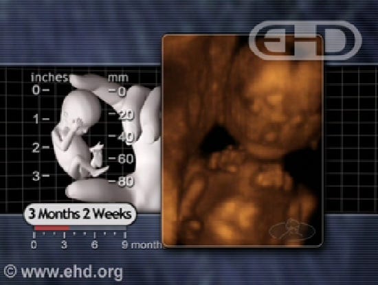 sonogram at 14 wks, Sex selective abortion