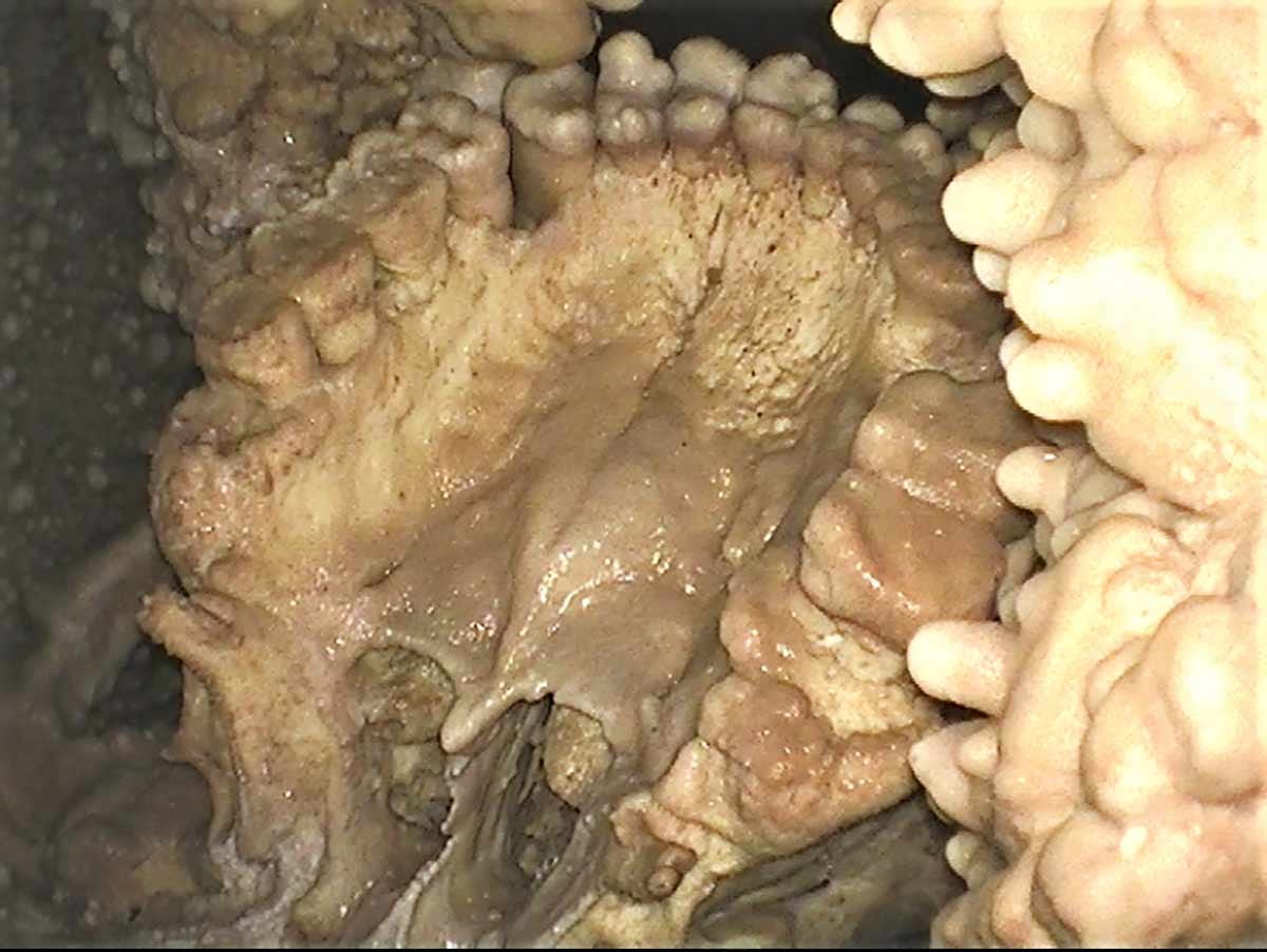 View of the palate and maxillary teeth of the Altamura Neanderthal, with surrounding encrustation of calcite View of the palate and maxillary teeth of the Altamura Neanderthal, with surrounding encrustation of calcite