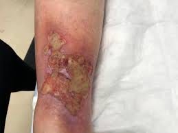 Biofilm — aspecto gelatinoso brillante