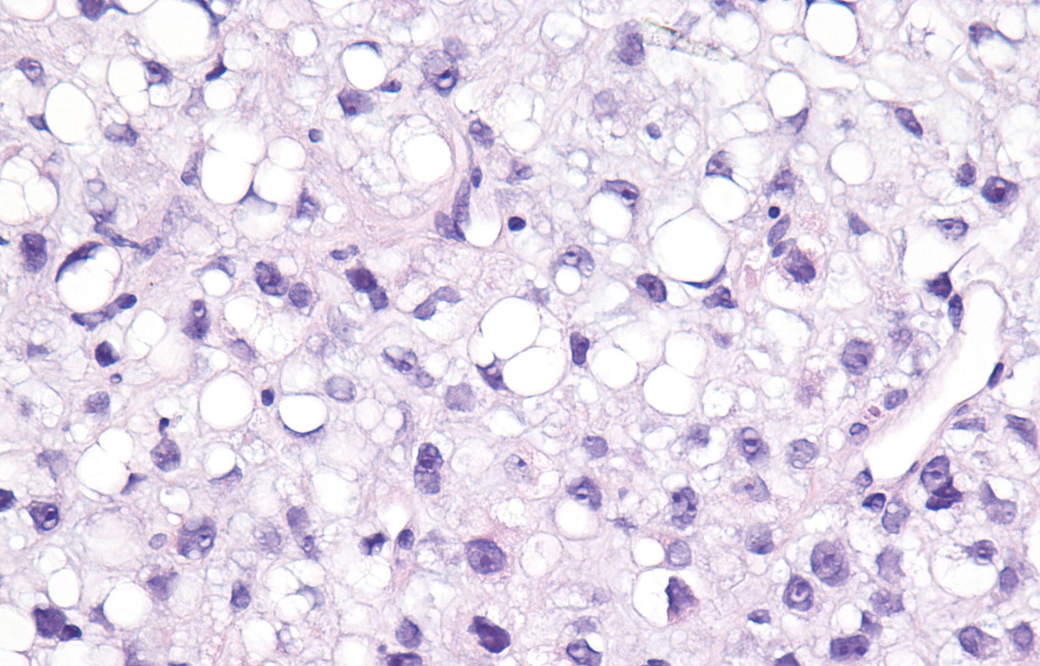 Myxoid Liposarcoma