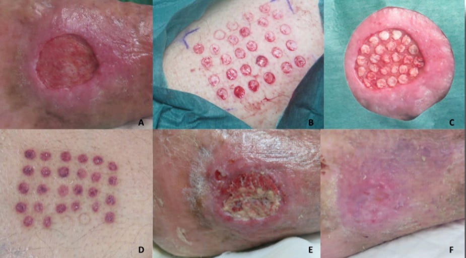 Microinjertos en sello — técnica autóloga para heridas crónicas estancadas