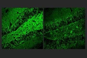Picower Institute researchers discovered that a molecule called A11 combats inflammation in the brain amid Alzheimer's disease. For example, A11-treated Alzheimer's model mice (right) showed much less tau protein (green staining), a hallmark of disease pathology, than untreated controls (left).