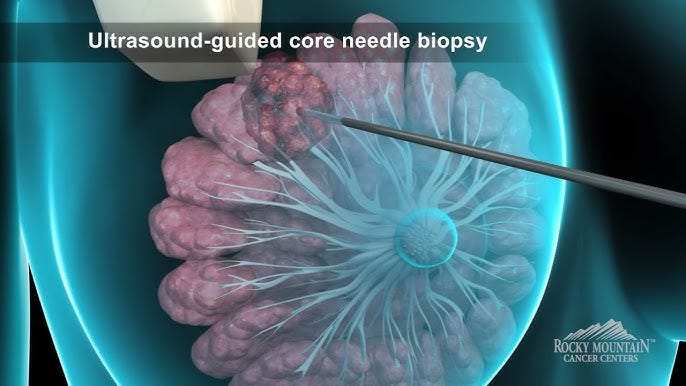 Breast Biopsy Animation