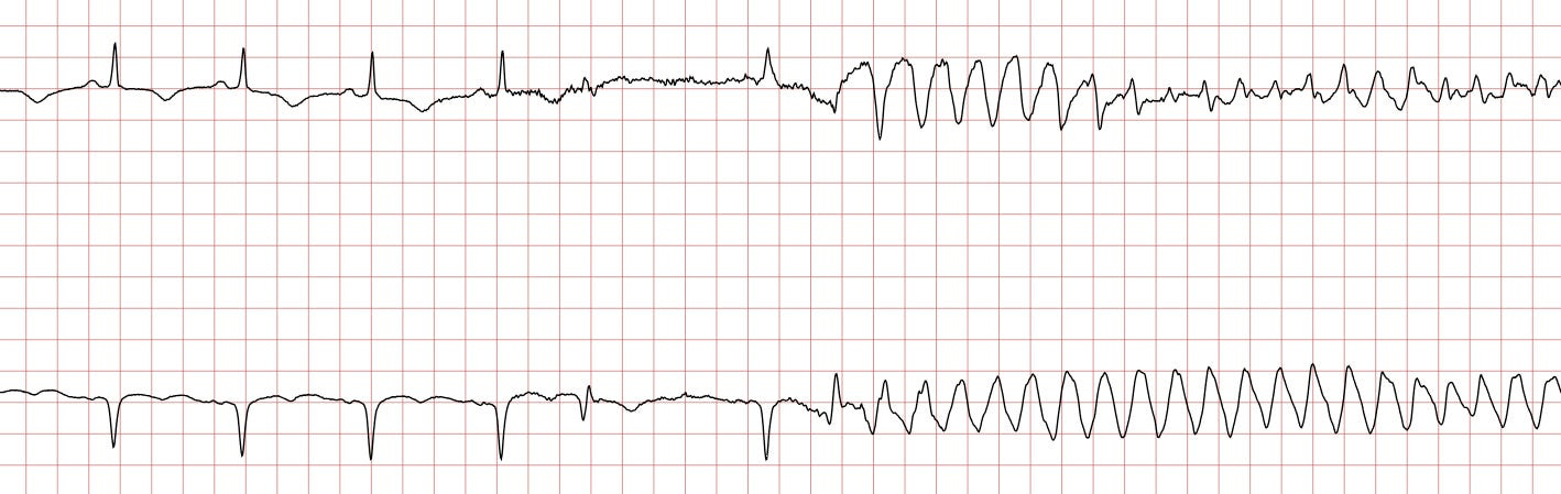 Ventricular tachycardia (VT): ECG criteria, causes, classification,  treatment – The Cardiovascular