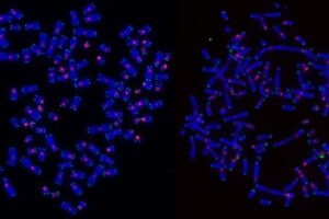 Chromosomes from cancer cells with DNA stained blue, telomeres stained green, and centromeres stained pink.