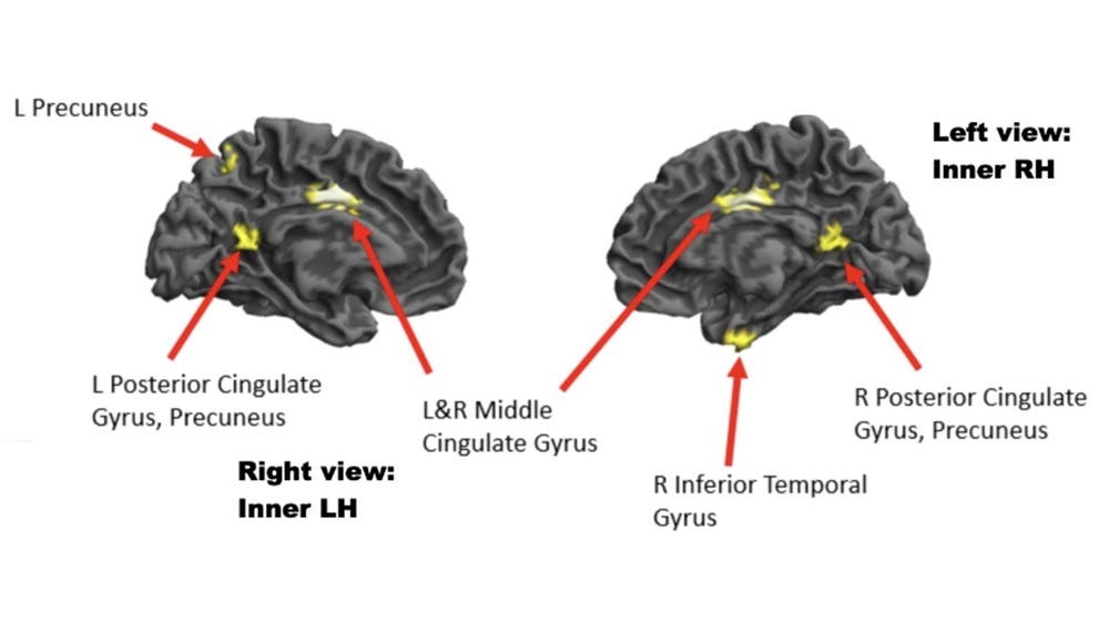Inner views of the left and right sides of the brain showing areas of reduced brain activity when the high-experience musicians were in a high-flow state (compared to a low-flow state). These areas include key nodes of the brain’s default-mode network. Image courtesy of Drexel University