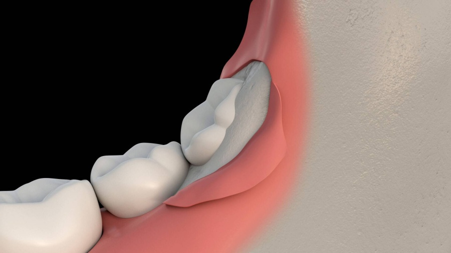 Wisdom Teeth Removal NY | Third Molars North Syracuse, Camillus,  Fayetteville, & Oneida