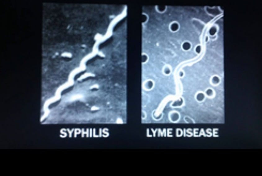 Staging of Morgellons disease holds promise of better treatments