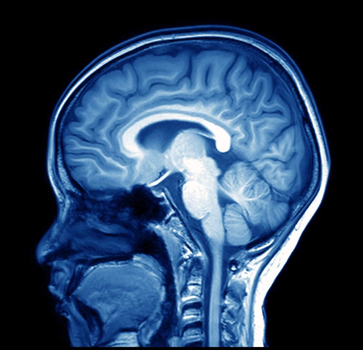 magnetic resonance image (MRI) of the brain - ODC