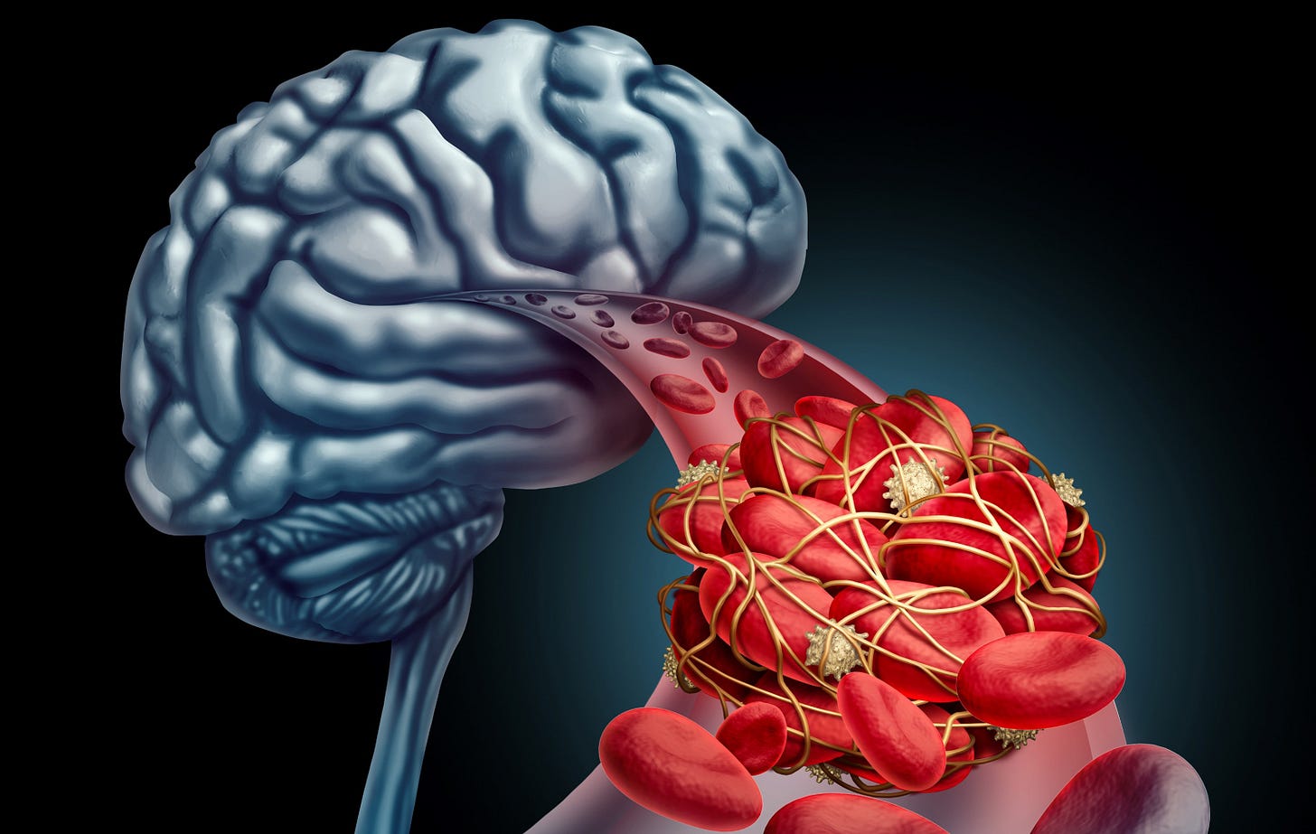 Intravenous thrombolysis in patients with ischemic stroke and DOAC intake -  VJNeurology